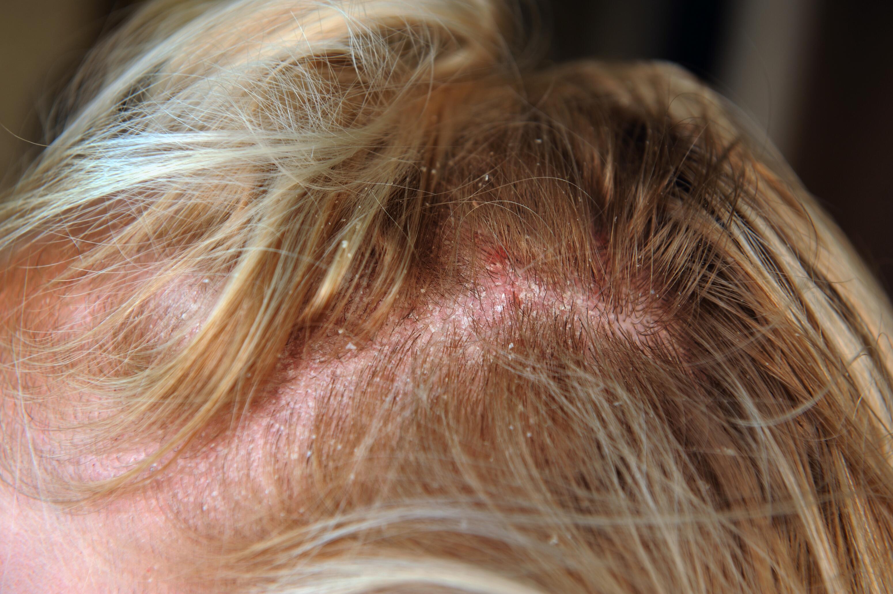 Dermatitis seborreica del cabello